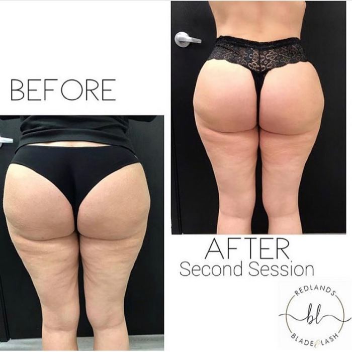 butt cupping client results