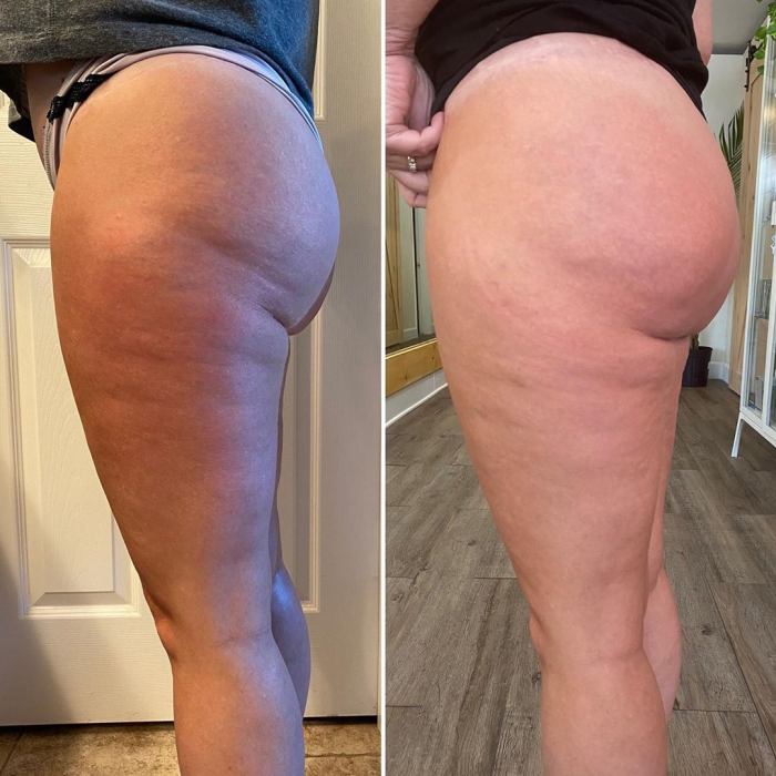 butt cupping client results