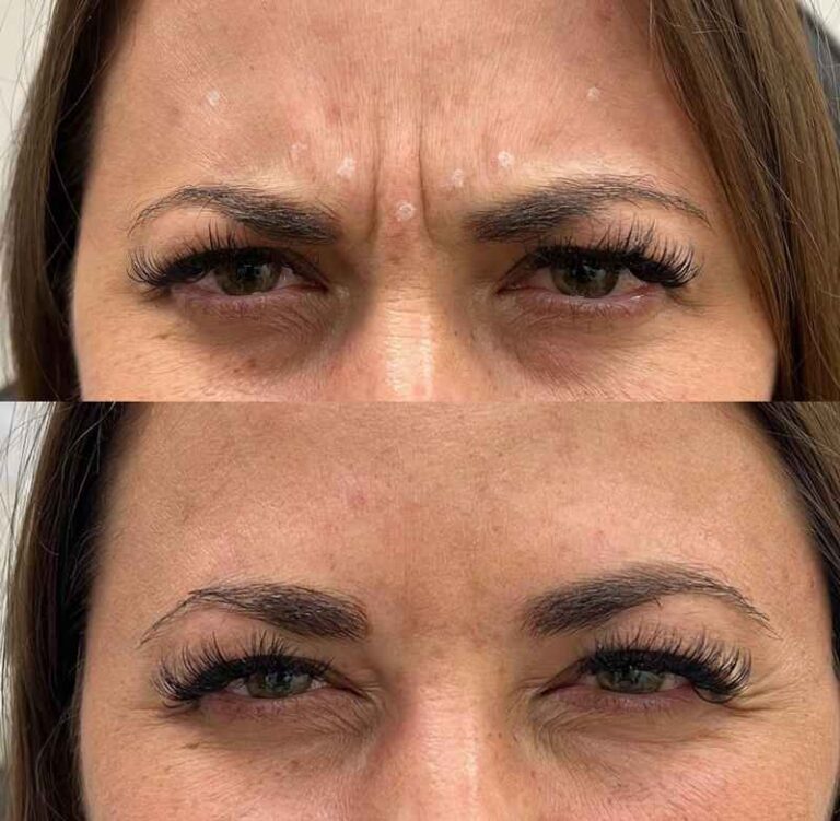 botox treatment before-after