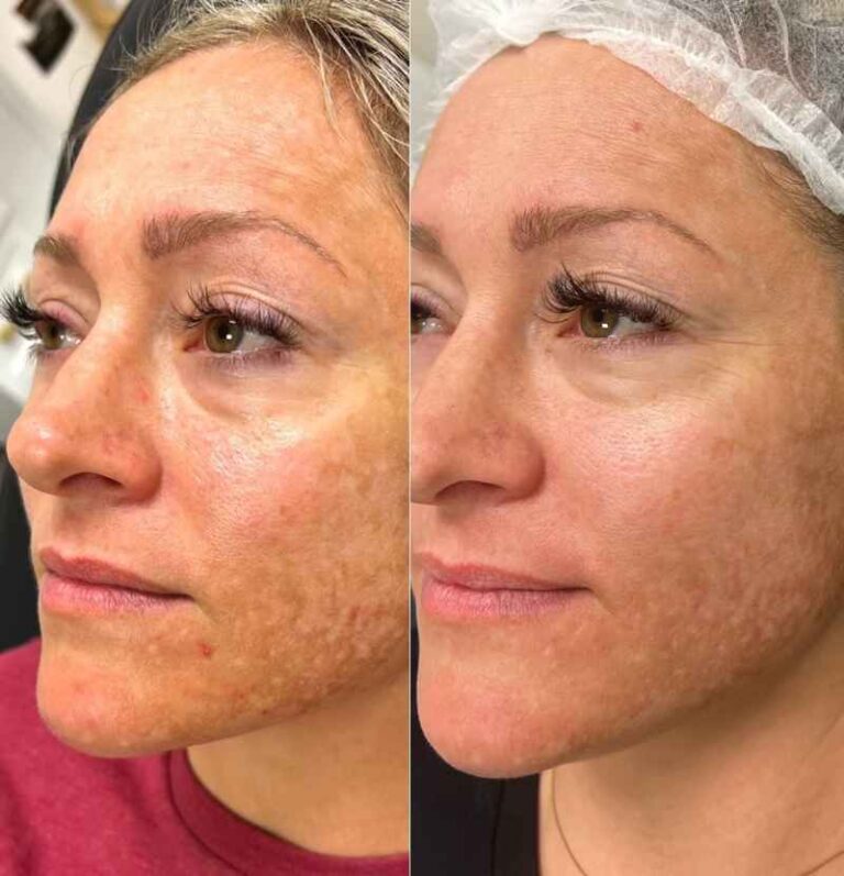 skin pen before and after